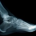 The cause of foot pain varies for each individual. A recognized cure for common foot ailments such as stress fractures, ankle sprains and heel pain is physiotherapy. Tendonitis is also […]